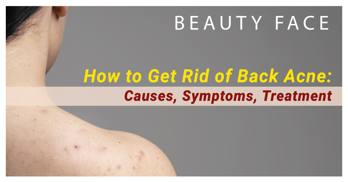 Back Acne (“Bacne”): Symptoms, Causes & Treatment